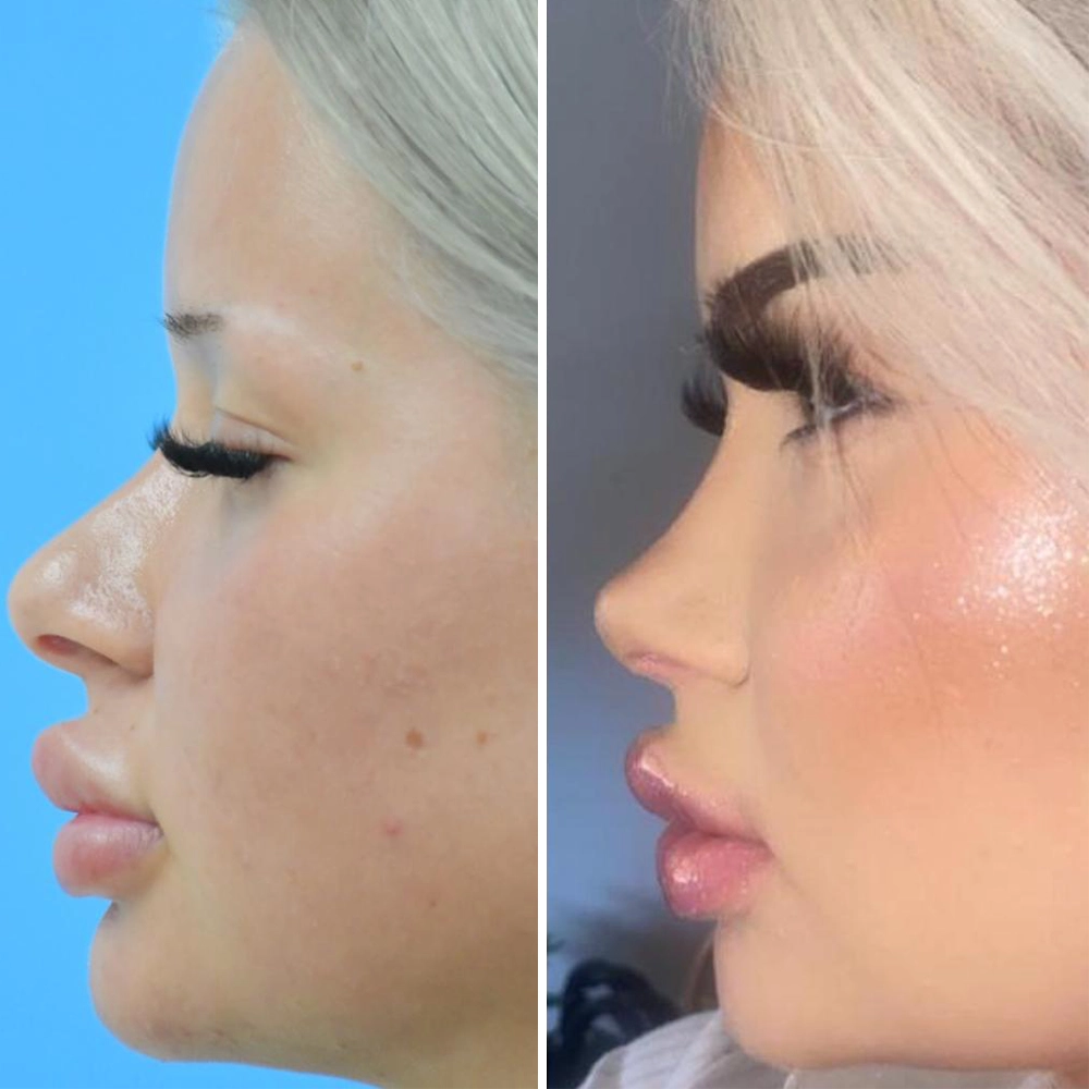 Facelift Patient